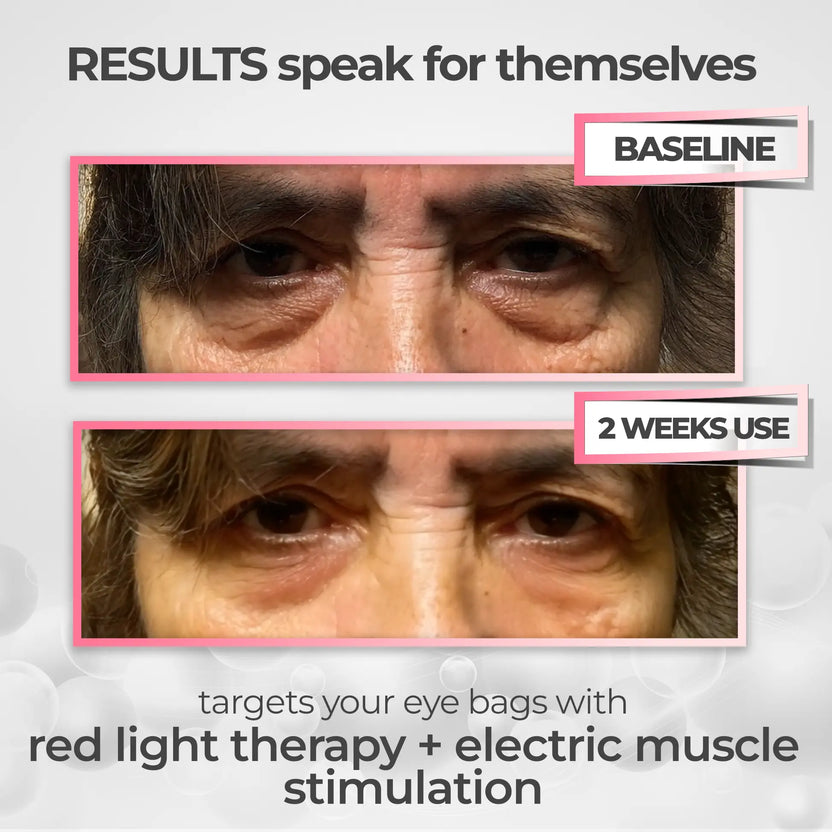 LumiEyes under-eye red light therapy image 2