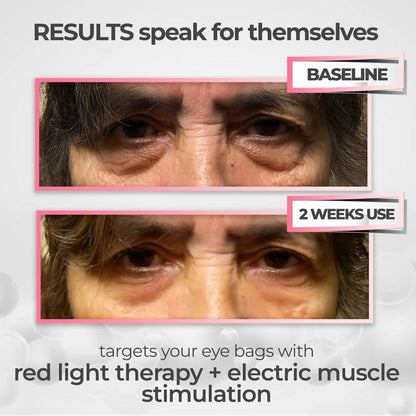 LumiEyes under-eye red light therapy image 2