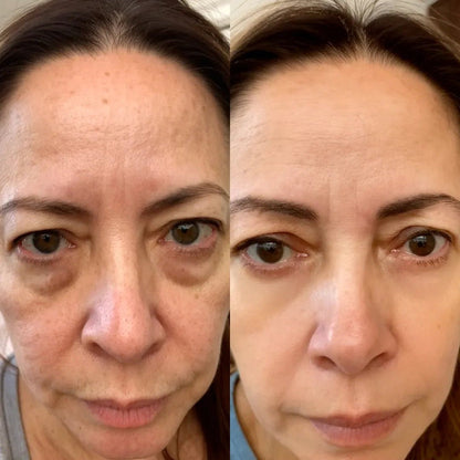 LumiEyes under-eye red light therapy image 5